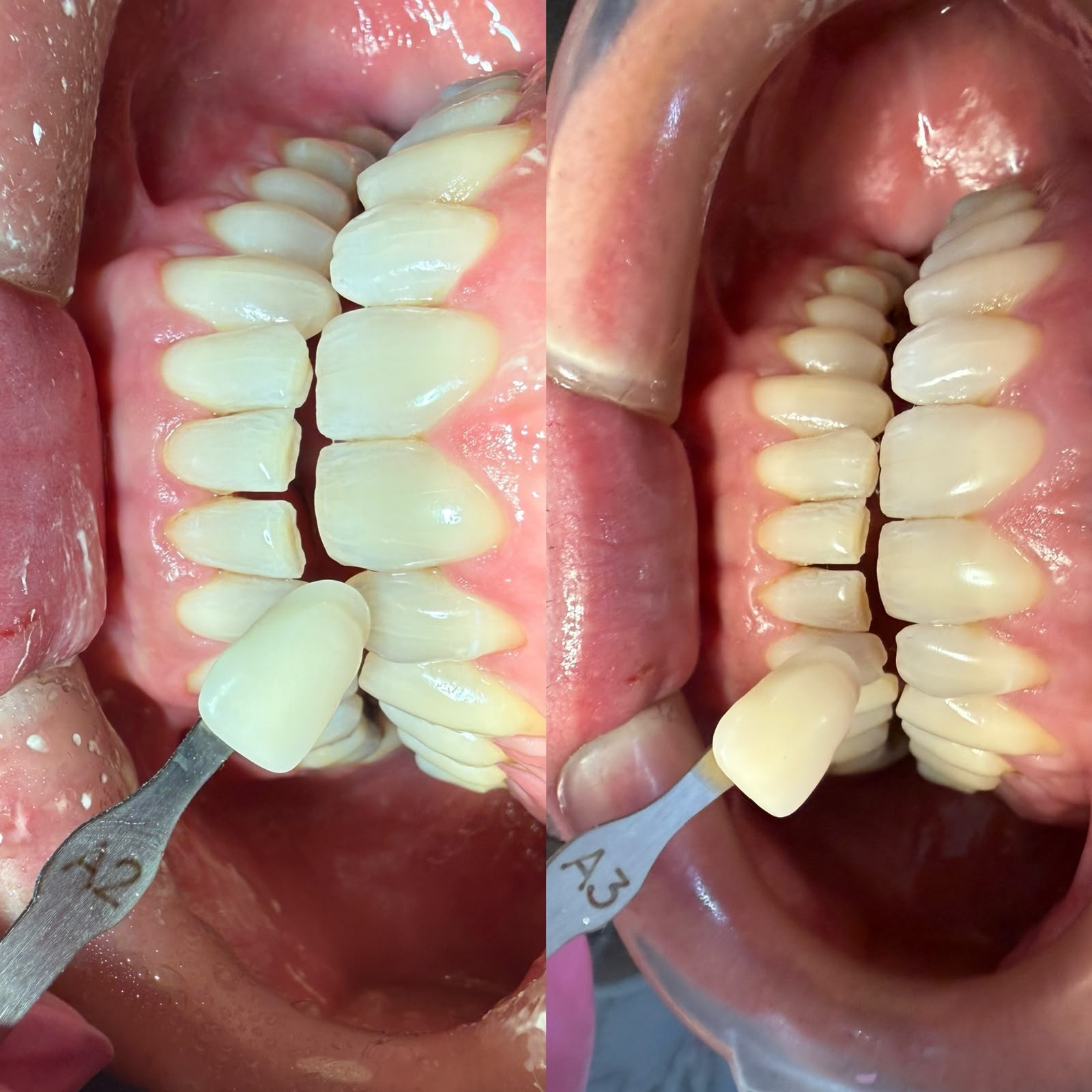 Clareamento dental com comparação de cor antes e depois