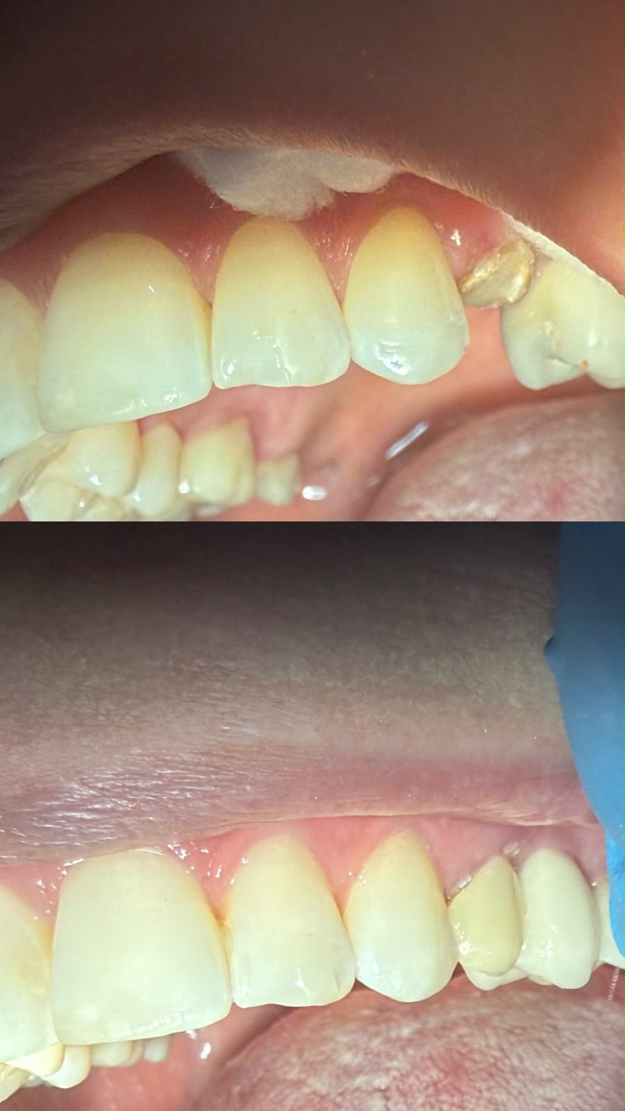 Prótese provisória imediata, antes e depois